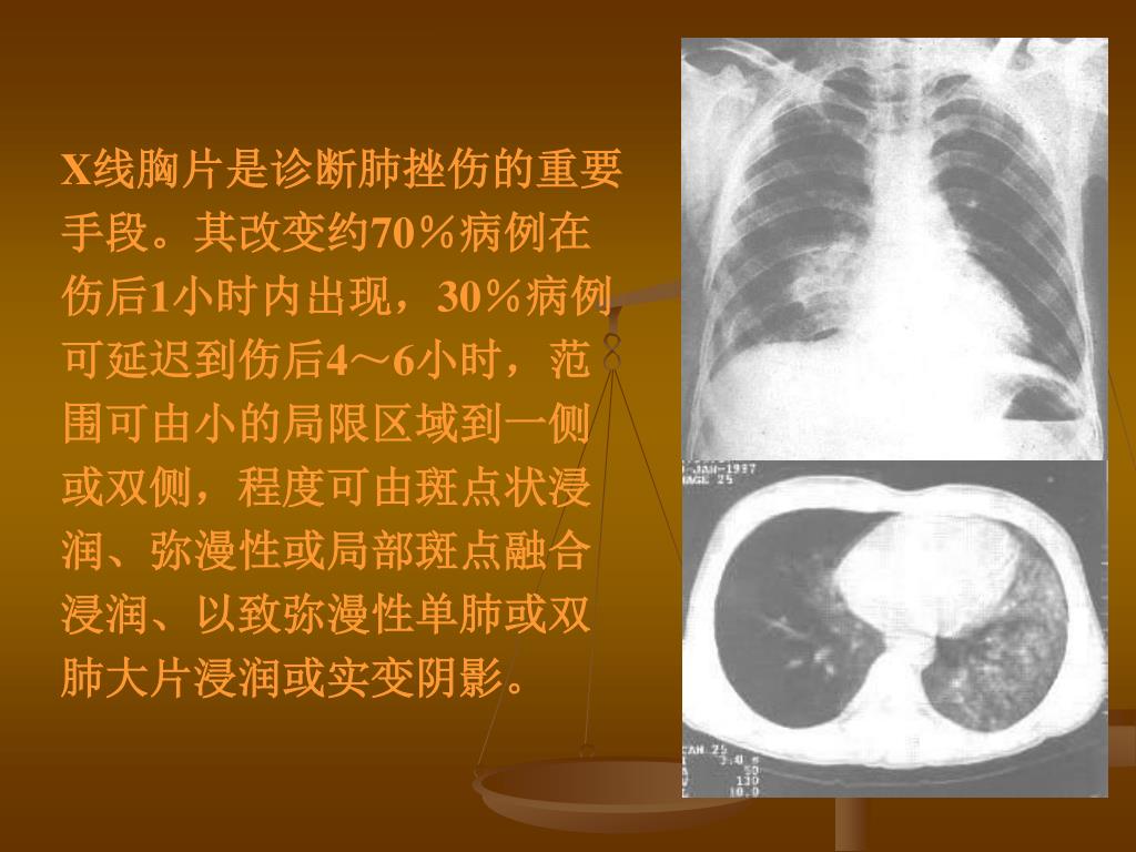 Ppt 创伤性血气胸的紧急处理与转诊powerpoint Presentation Id Ppt 创伤性血气胸的紧急处理与转诊powerpoint Presentation Id