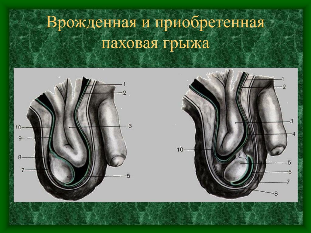 Паховая Грыжа Симптомы Фото