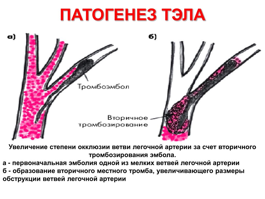 Что такое тромбоэмболия легочной артерии простыми. Тромбоэмболия ветвей легочной артерии. Тромбоэмболия легочной артерии этиология. Тэла патогенез.