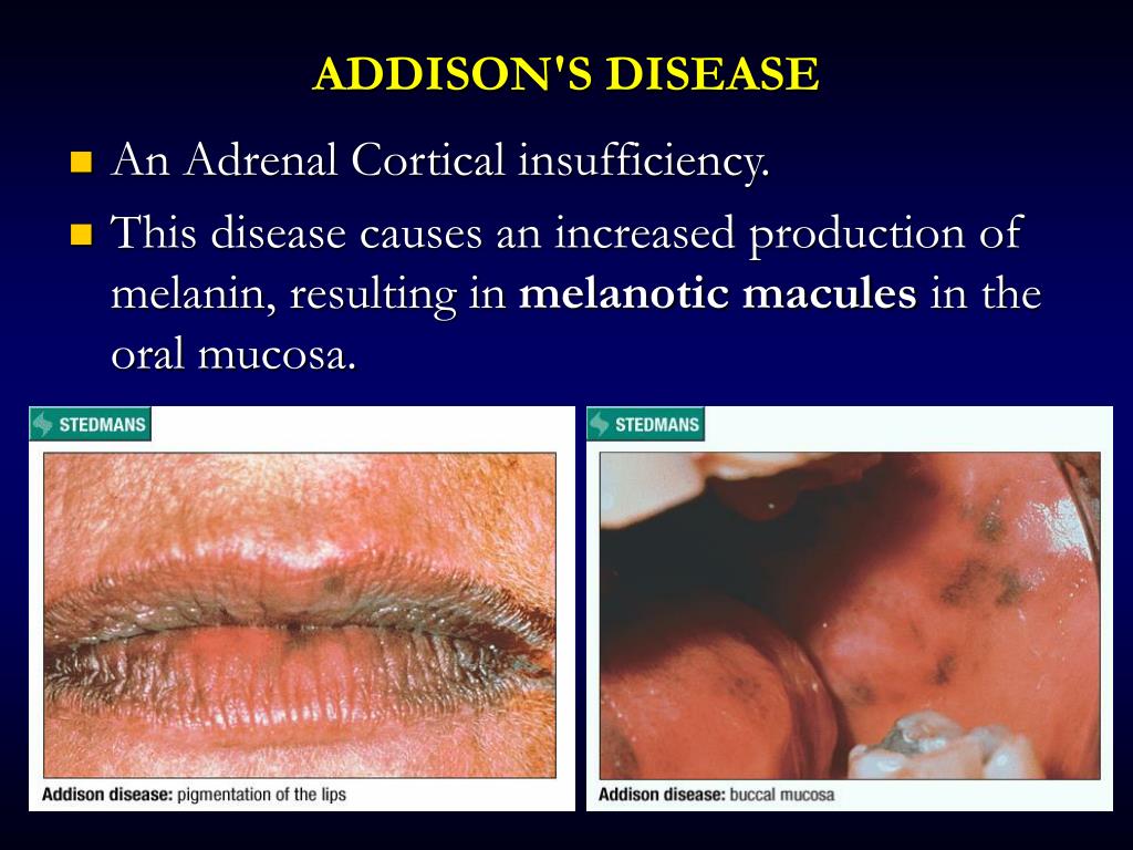 Addisons Disease Oral