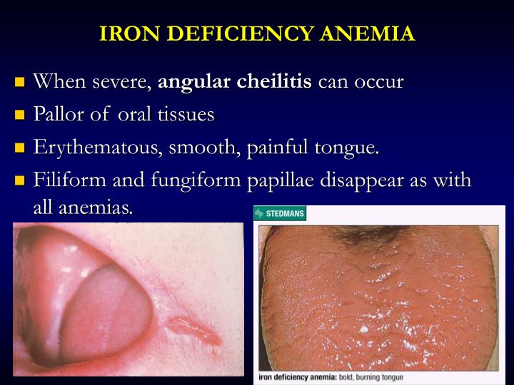 Iron Deficient Rash PPT - Oral Manifestations of Systemic Diseases PowerPoint Presentation ...