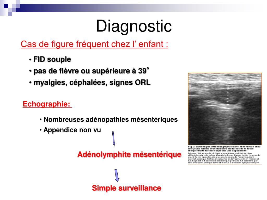 PPT - Appendicite Aiguë PowerPoint Presentation, free download - ID:5563234