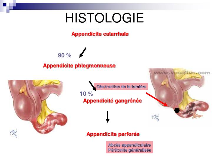 PPT - Appendicite Aiguë PowerPoint Presentation - ID:5563234