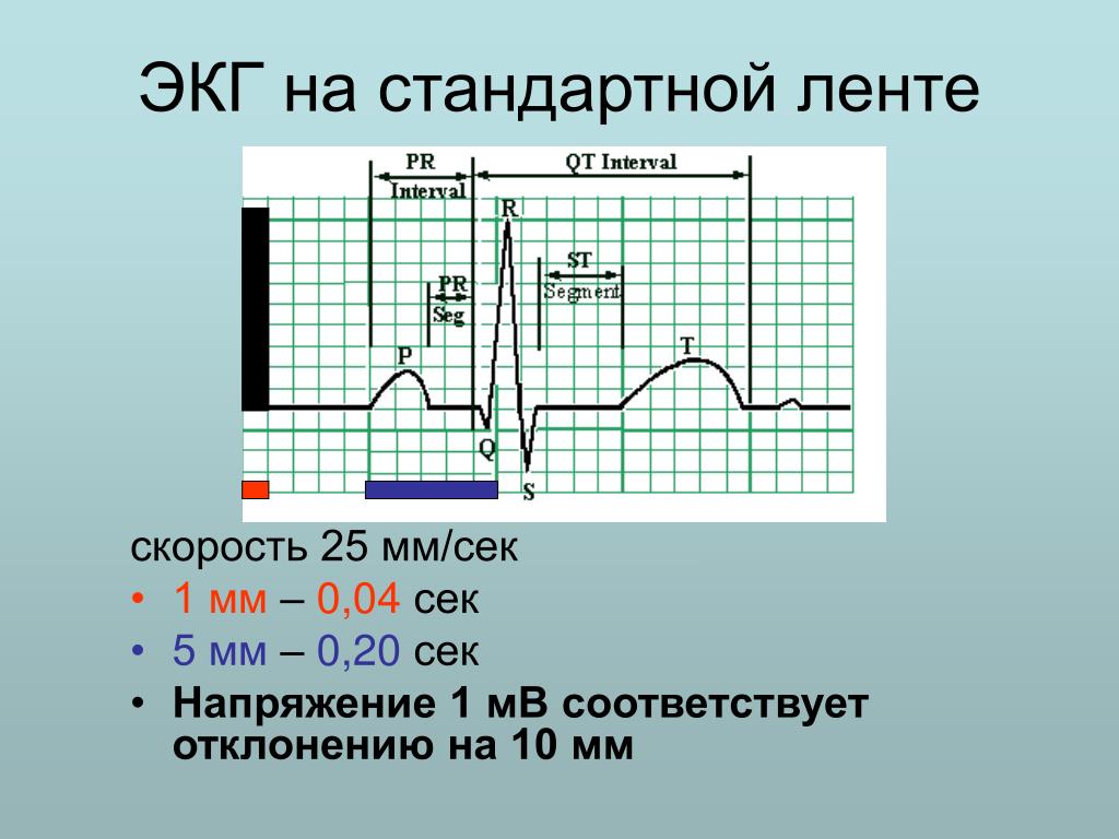 Как измерить частоту сердечных. Скорость записи ЭКГ 25 мм с. Скорость записи 50 мм в сек ЭКГ. Вольтаж 50 мм ЭКГ норма. Скорость ленты ЭКГ 50.