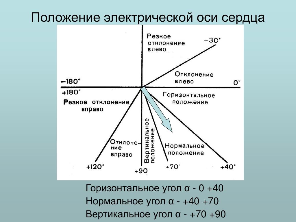 Электрическая ось сердца нормальная. Положение электрической оси сердца отклонение. Таблица для определения электрической оси сердца. Вертикальная ось сердца. Вертикальное положение оси сердца.