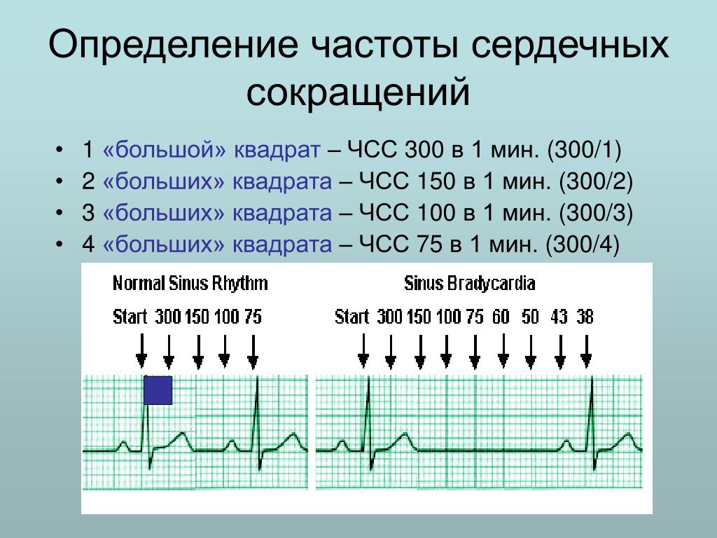 10 мс частота. Подсчет ЧСС на ЭКГ 25 мм/с. Подсчёт ЧСС по ЭКГ 50 мм. Как считать ЧСС по ЭКГ 50 мм. Частота сердечных сокращений на ЭКГ 50мм.