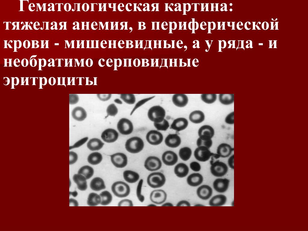 Тяжелая анемия. Мишеневидные эритроциты анемия. Мишеневидные и серповидные эритроциты. Мишеневидные эритроциты в крови. Мишеневидные эритроциты обнаруживаются в крови при.