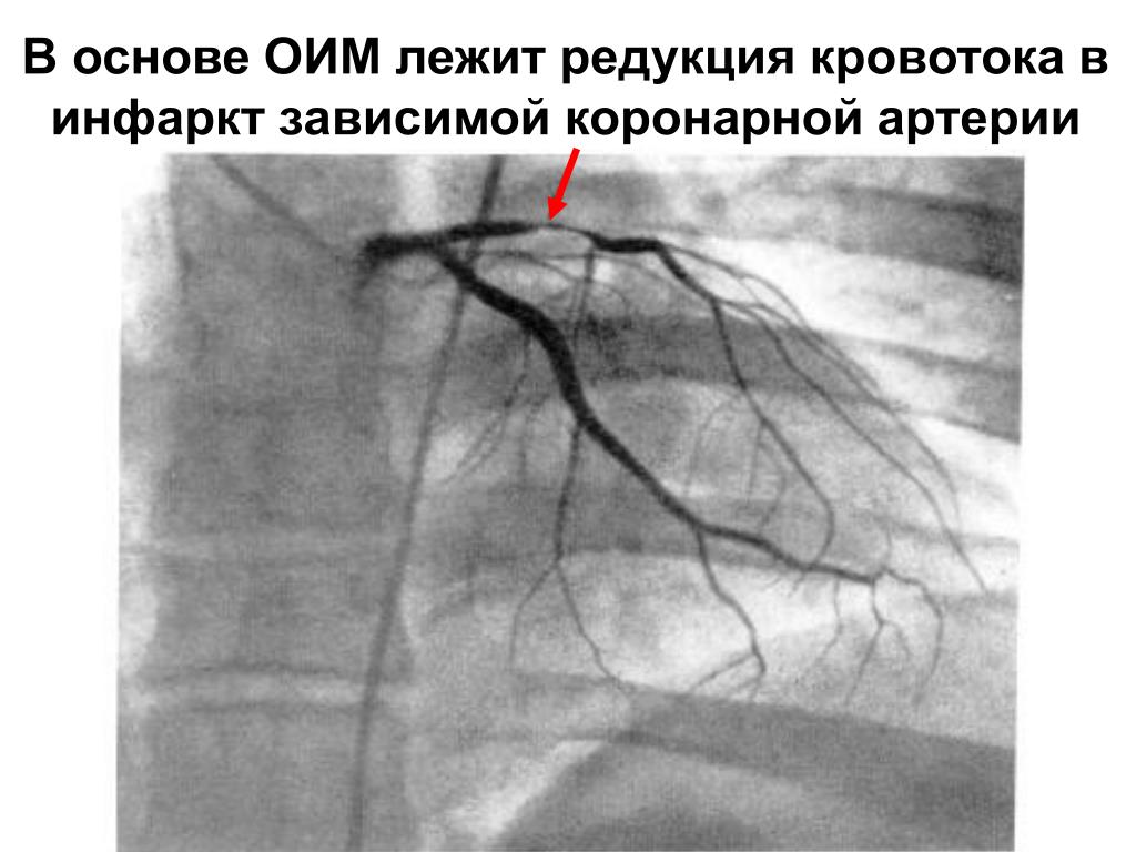 Тромбоз коронарных артерий. Окклюзия коронарных артерий клиника. Окклюзия огибающей артерии. Инфаркт миокарда окклюзия артерий. Окклюзия коронарной артерии на коронарографии.