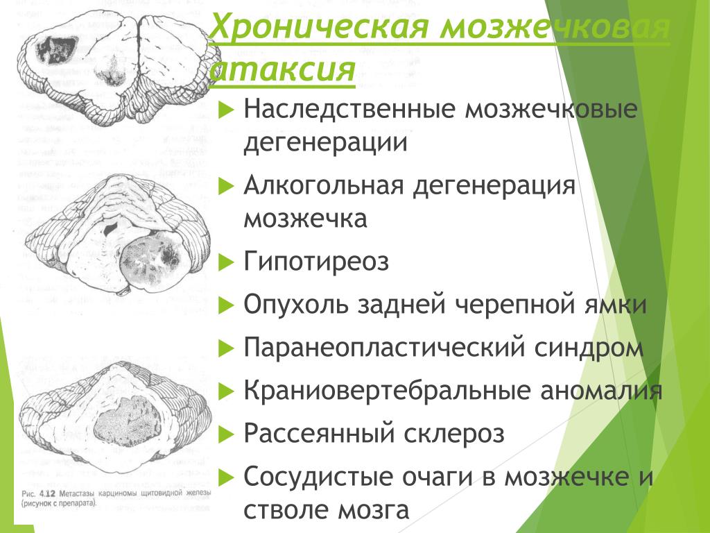 Синдромы мозжечка. Алкогольная дегенерация мозжечка. Синдром мозжечковой дегенерации. Наследственные мозжечковые дегенерации. Синдромы поражения мозжечка.