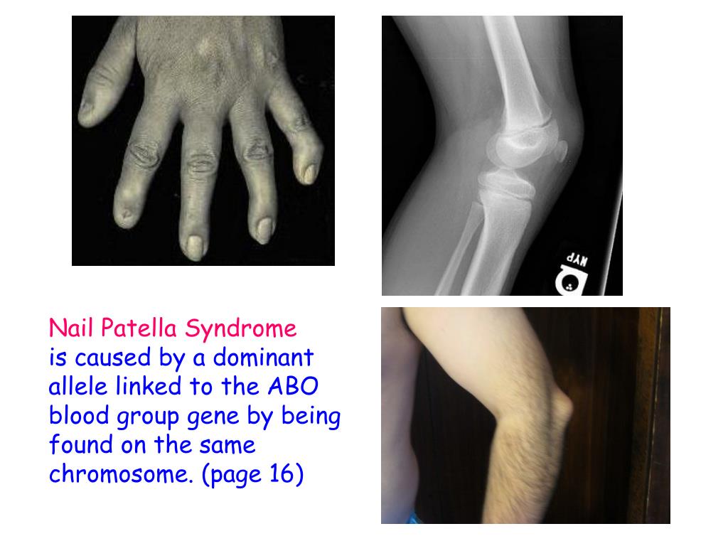 Patient With Nail Patella Syndrome | IMCRJ