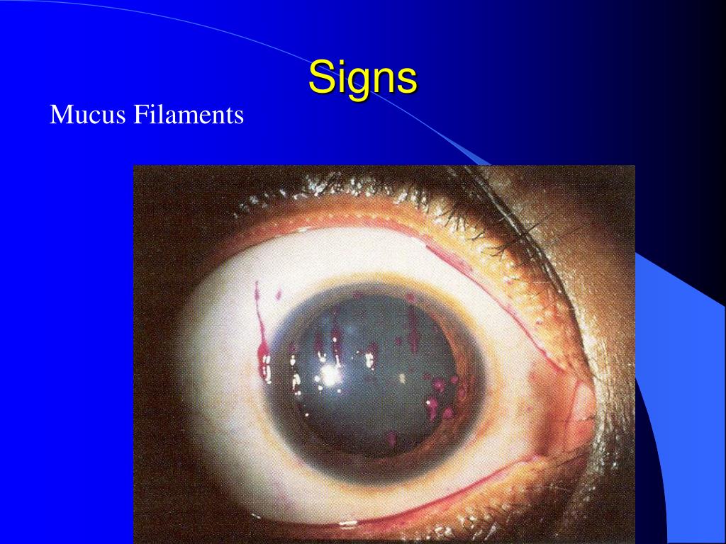 PPT Dry Eyes and Blepharitis PowerPoint Presentation, free download