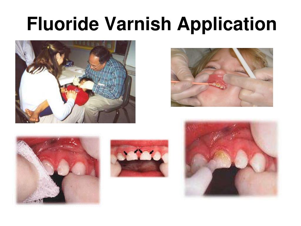 PPT Fluoride Varnish An Overview for Health Professionals PowerPoint