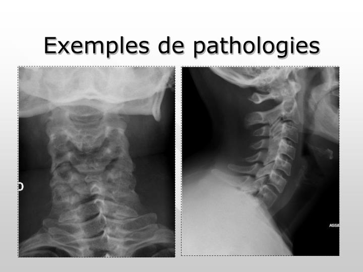 PPT - EXPLORATION RADIOLOGIQUE DU RACHIS CERVICAL ET LOMBAIRE ...