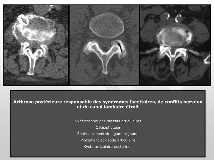 Arthrose Inter Apophysaire Postérieure L4 L5 L5-s1