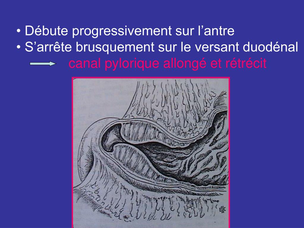 PPT - Sténose hypertrophique du pylore PowerPoint Presentation, free  download - ID:5594693