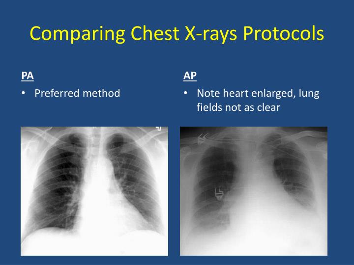 PPT Basics Of Chest X Ray PowerPoint Presentation ID 5595574 ppt-basics-of-chest-x-ray-powerpoint-presentation-id-5595574
