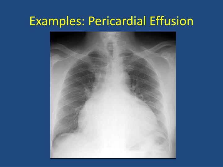 PPT - Basics of Chest X-Ray PowerPoint Presentation - ID:5595574