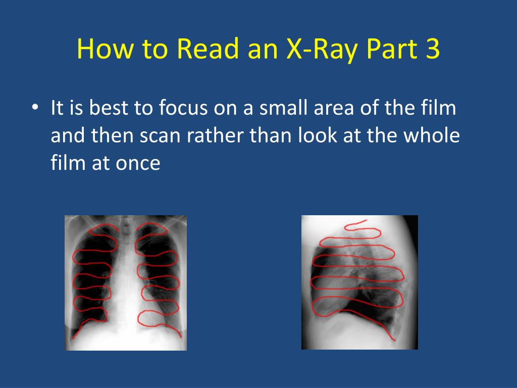 PPT - Basics Of Chest X-Ray PowerPoint Presentation, Free Download - ID ...