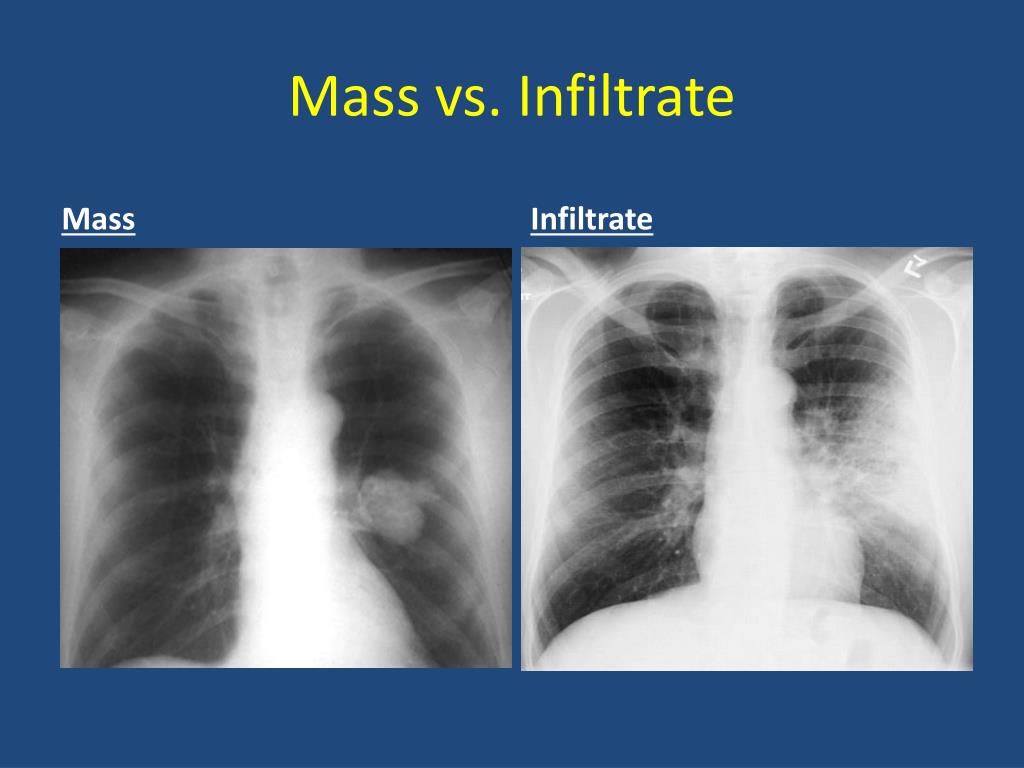 PPT - Basics of Chest X-Ray PowerPoint Presentation, free download - ID