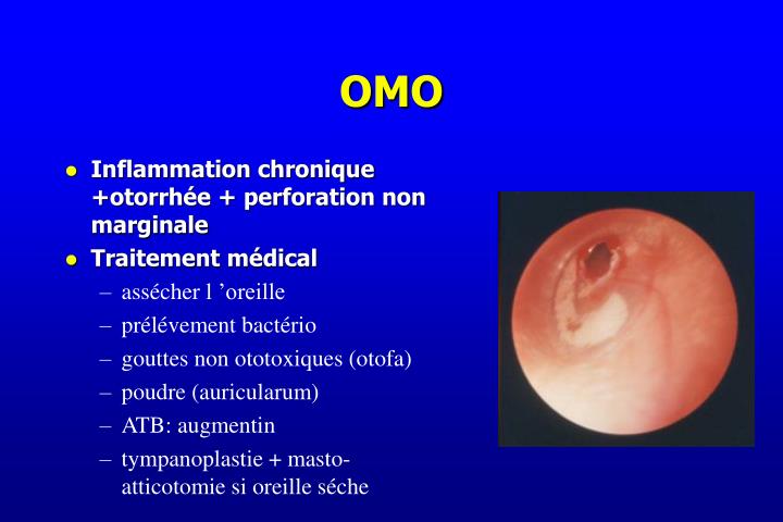 PPT Otalgie Otites PowerPoint Presentation ID 5597849 PPT Otalgie Otites PowerPoint Presentation ID 5597849