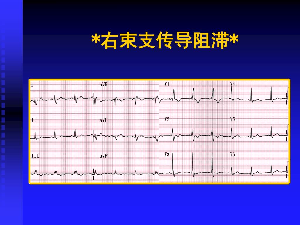 Ppt 第五节心律失常powerpoint Presentation Free Download Id Ppt 第五节心律失常powerpoint Presentation Free Download Id
