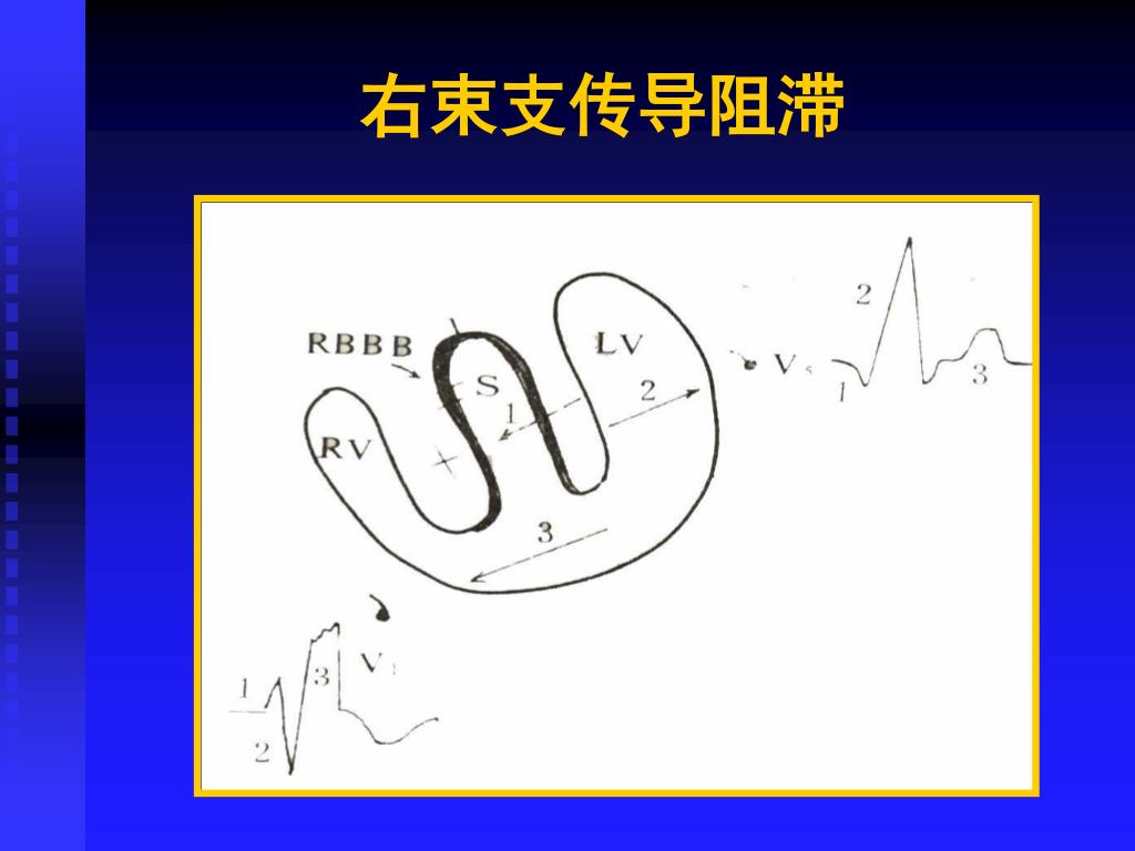 Ppt 第五节心律失常powerpoint Presentation Free Download Id Ppt 第五节心律失常powerpoint Presentation Free Download Id