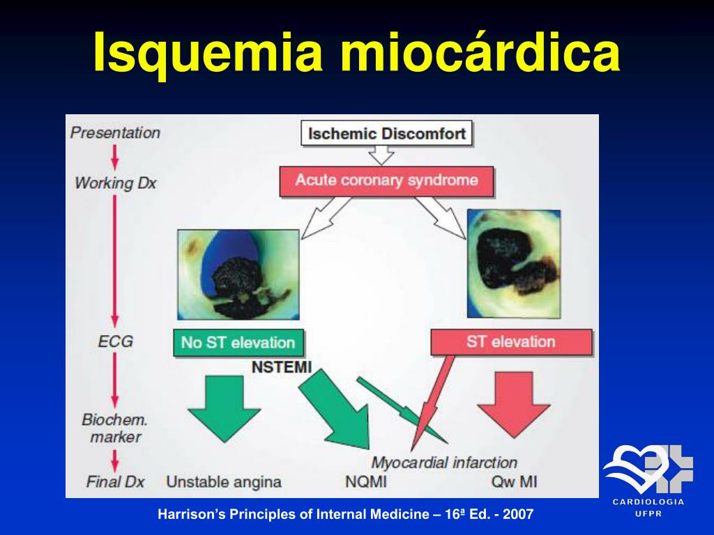 PPT - Cardiopatia Isquêmica Conceito, Fisiopatologia e Avaliação ...