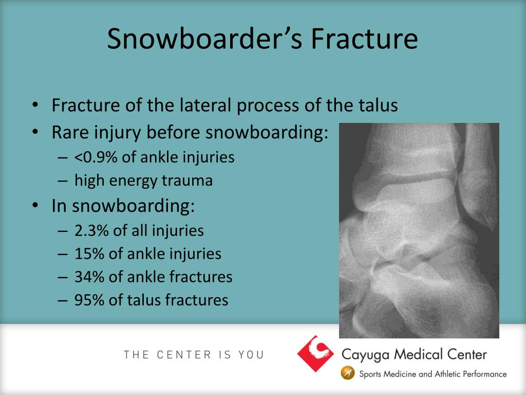 PPT - Snowboarding Injuries Greak Peak Expo Oct 30, 2010 ...