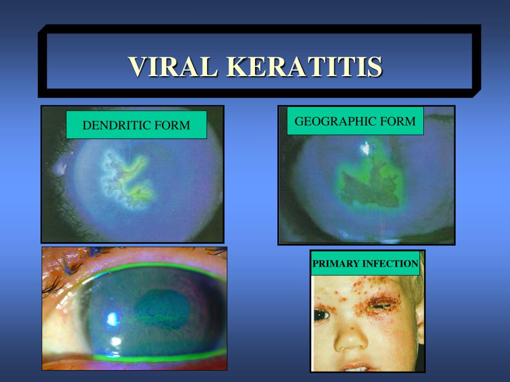 presentation of viral keratitis