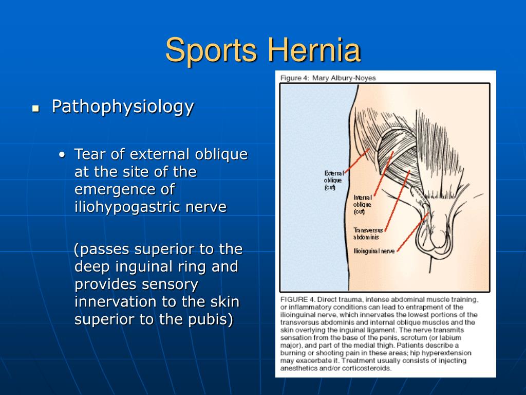 Ppt Sports Hernia Powerpoint Presentation Free Download Id5632534
