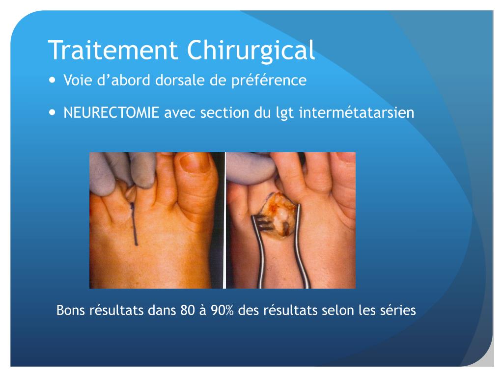 PPT NEVROME DE MORTON PowerPoint Presentation, free download ID5634836