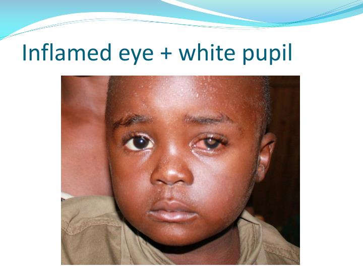 PPT Retinoblastoma PowerPoint Presentation ID5637636