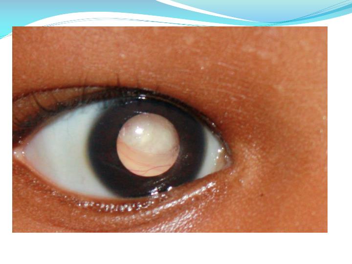 PPT Retinoblastoma PowerPoint Presentation ID5637636