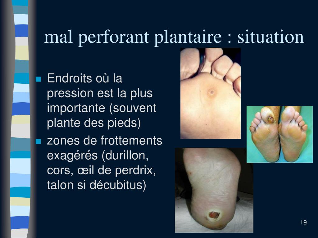 PPT - Le pied diabétique PowerPoint Presentation, free download - ID:5645006