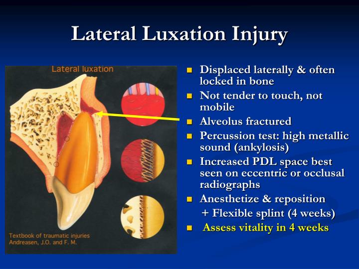 PPT Traumatic Injuries, Cracked Teeth and vertical root fractures