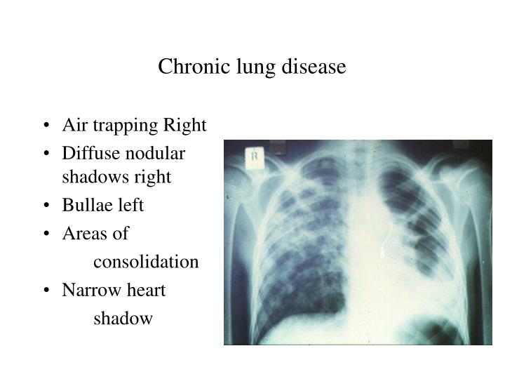 rales lung sounds cause rales lung sounds cause