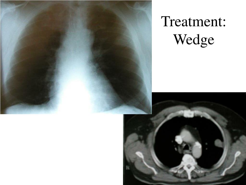 PPT - Surgical Management of Lung Cancer PowerPoint Presentation, free