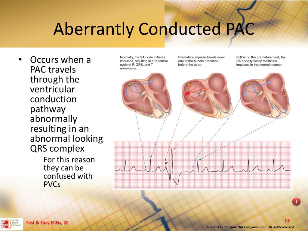 PPT Atrial Dysrhythmias PowerPoint Presentation, free download ID