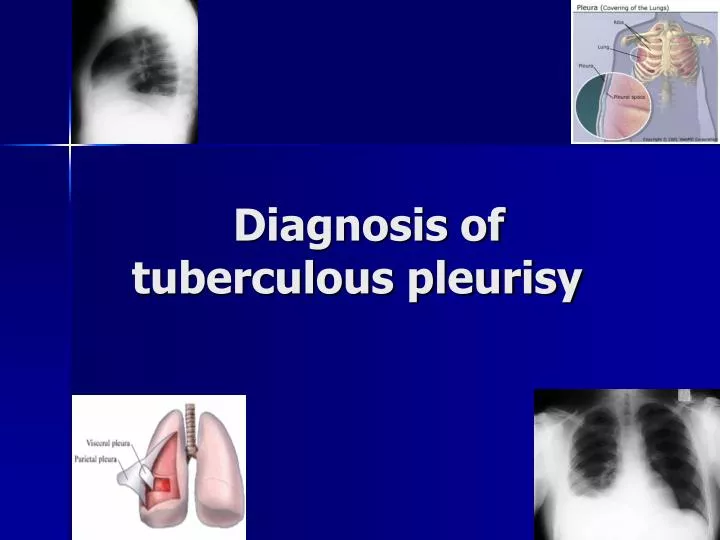 Ppt Diagnosis Of Tuberculous Pleurisy Powerpoint Presentation Free