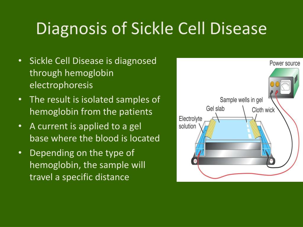 How Is Sickle Cell Disease Diagnosed