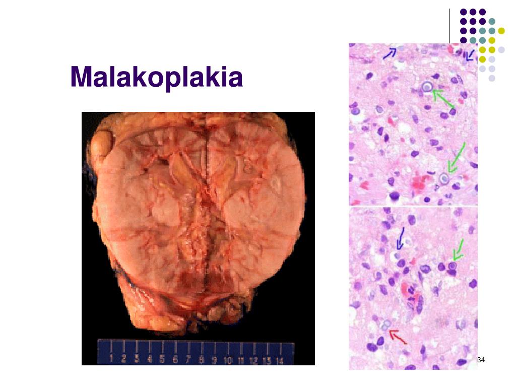 PPT Urinary System Outflow Obstruction And Urinary System Tumors 