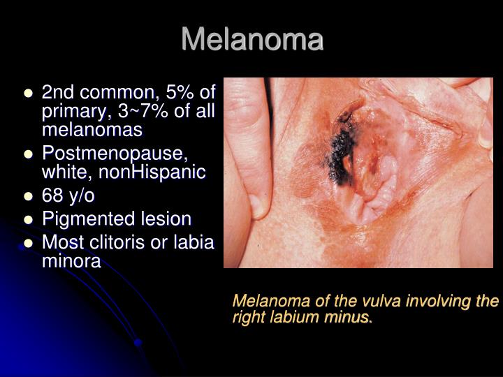 melanoma on the vagina Naked girls sex