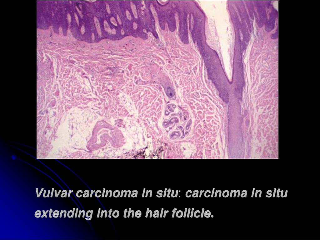 Vicenta recommends best of Precancer of the vulva Adult Video My friend sucked my dick