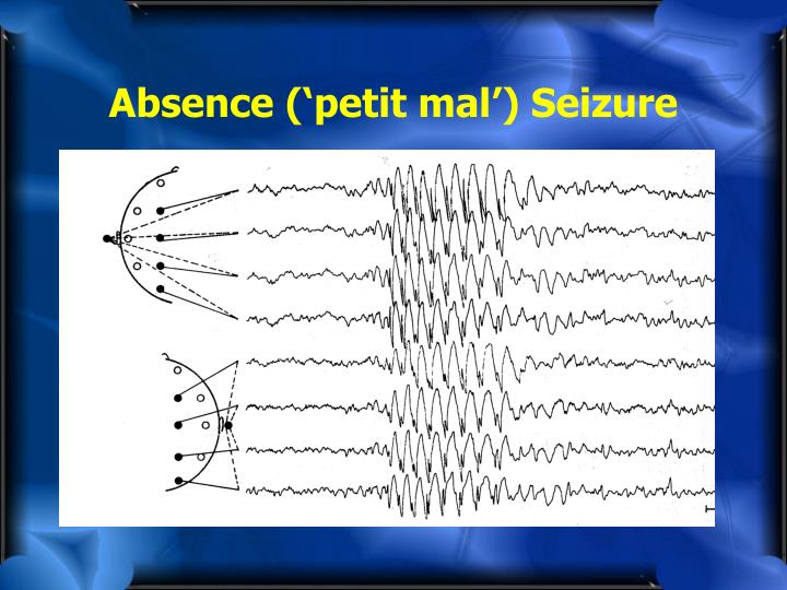 PPT Neuropsychology of Epilepsy PowerPoint Presentation ID5668743