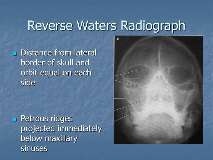 PPT Radiography of the Orbits PowerPoint Presentation ID5669687