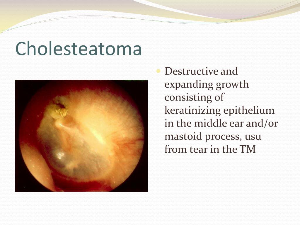 PPT Otitis Media PowerPoint Presentation Free Download ID 5669922