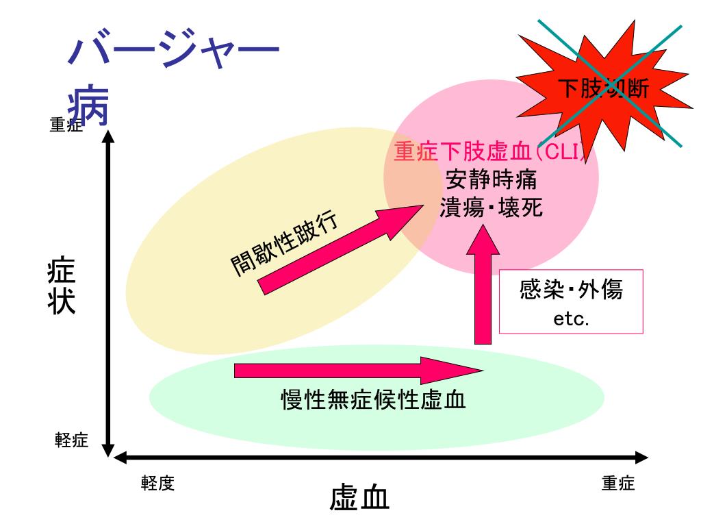 バージャー病の治療選択肢