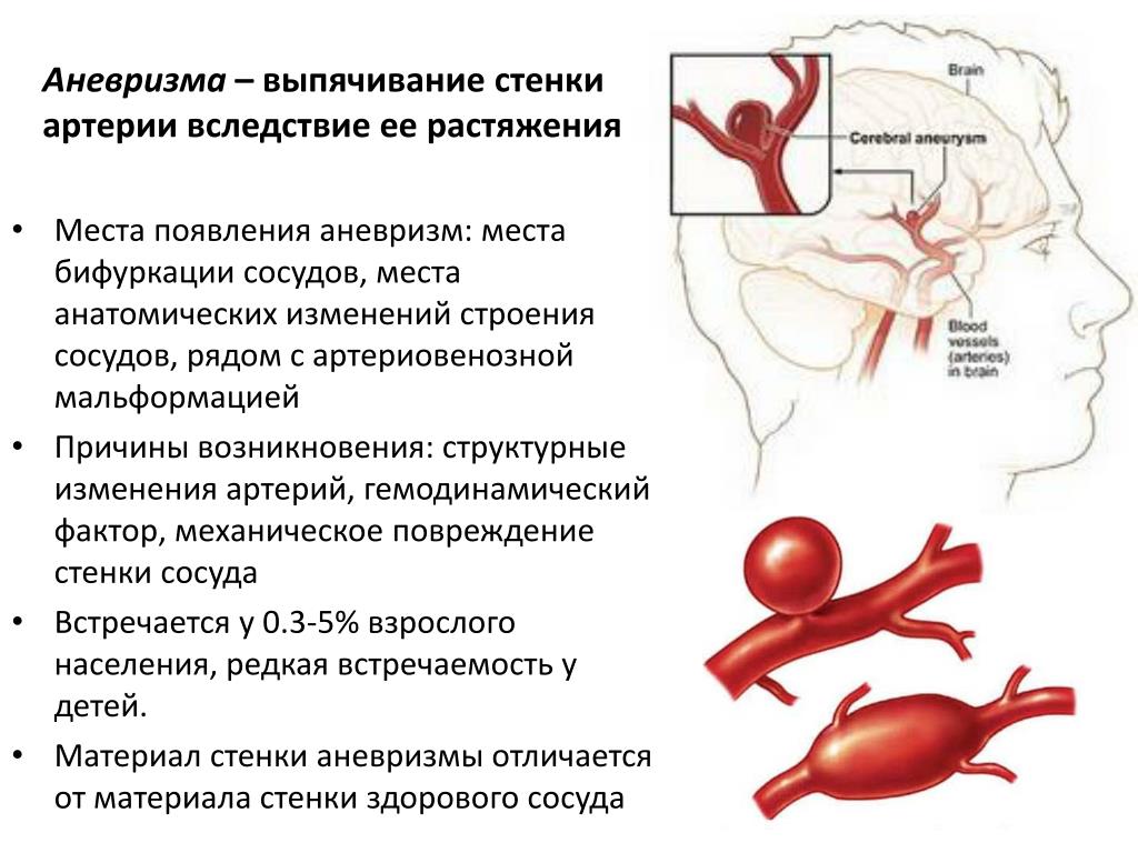 Аневризма сонной артерии что это. Аневризма артерий симптоматика. Аневризма селезеночной артерии кт. Мешотчатая аневризма сосудов. Аневризма сосудов головного мозга классификация.