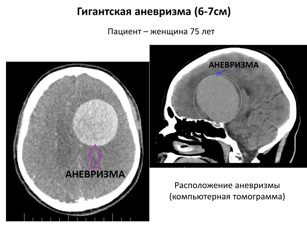 Форум аневризма мозга. Гигантская аневризма головного мозга. Аневризма сосудов головного мозга кт. Аневризма вен головного мозга кт. Мешотчатая аневризма головного мозга кт мрт.