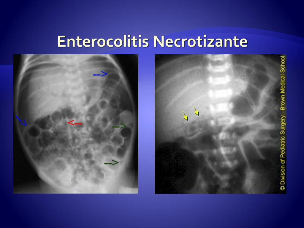 PPT - Enterocolitis Necrotizante ECN PowerPoint ...